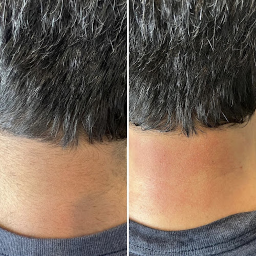 Spring Valley Laser hair removal