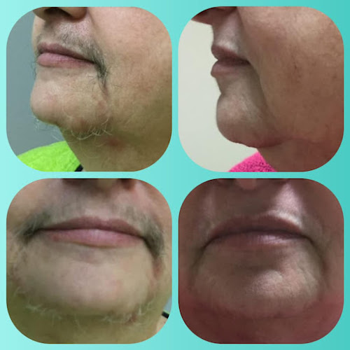 Soleil Laser Hair Removal