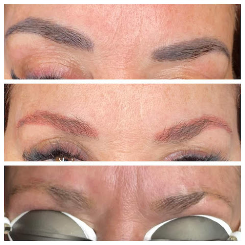 Reverse Hex Tattoo Removal