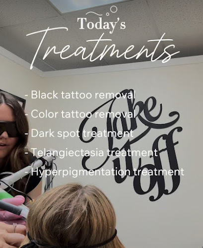 Take it Off Laser Tattoo Removal