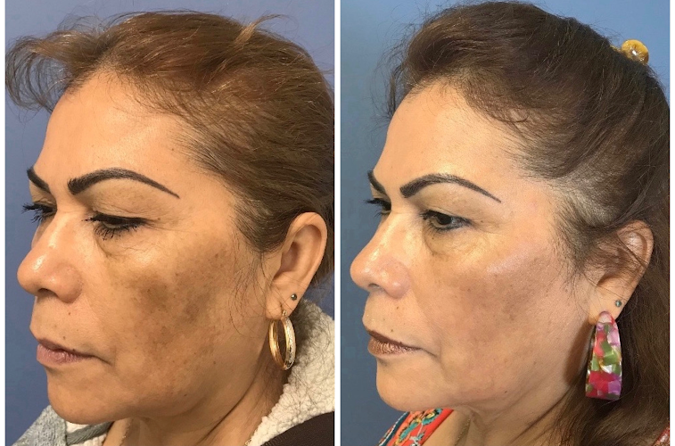 Renew Aesthetic & Laser Clinic in Portland