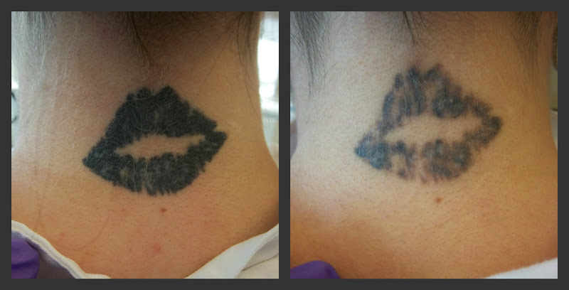 Tattoo Must Go and Aesthetics - Laser Tattoo Removal Service