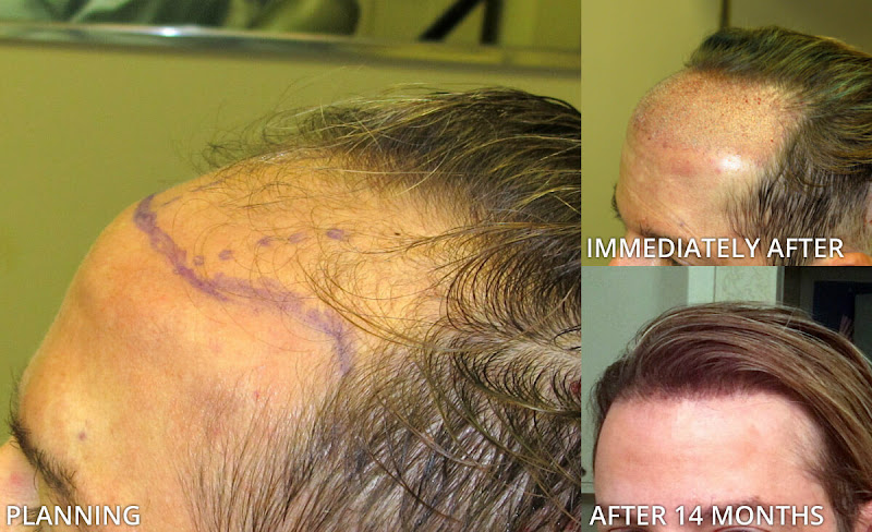 ARTAS - ROBOTIC HAIR TRANSPLANT CENTER