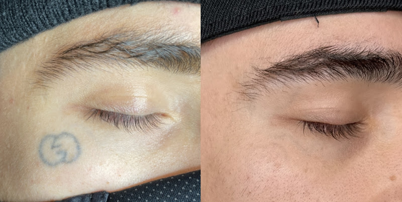 Take It Off Tattoo Removal and Alt Spa