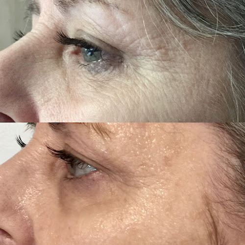 Collagen Bar NYC Microneedling and Body Contouring