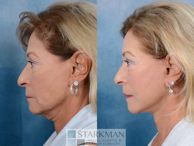 Starkman Facial Plastic